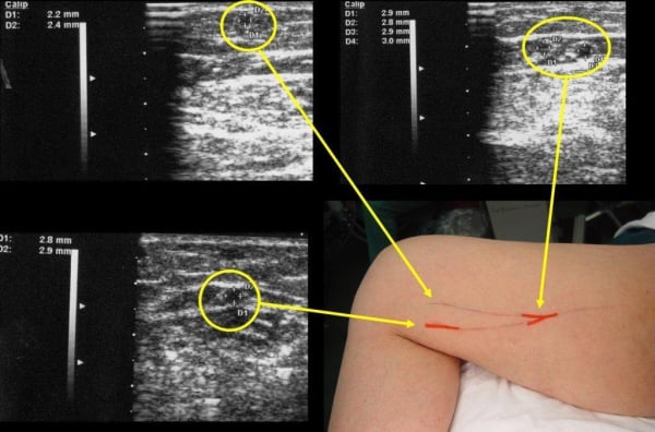 Έγχρωμο Υπερηχογράφημα Αγγείων