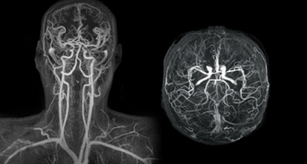 Μαγνητική Αγγειογραφία (MRA)